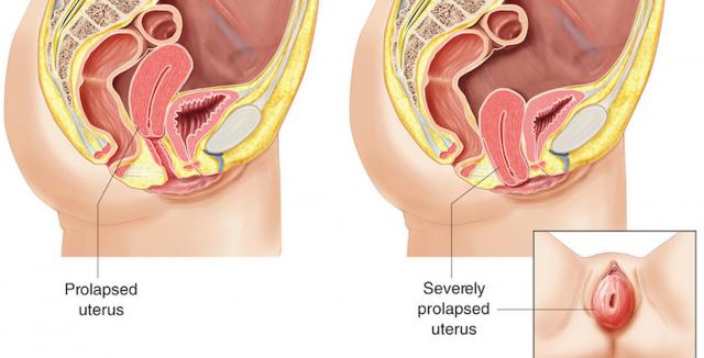 After Anal Sex Prolapse - Can You Get Prolapsed Uterus from Too Much Sex? | Betty Dodson & Carlin Ross